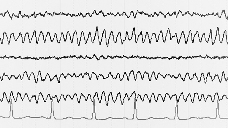 EEG - Poliklinik Rüdersdorf - Neurologie